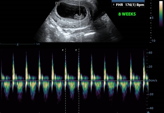 Featured image of post View 9 8 Days After Conception Heartbeat